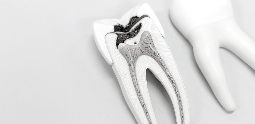 Root Canal Treatment