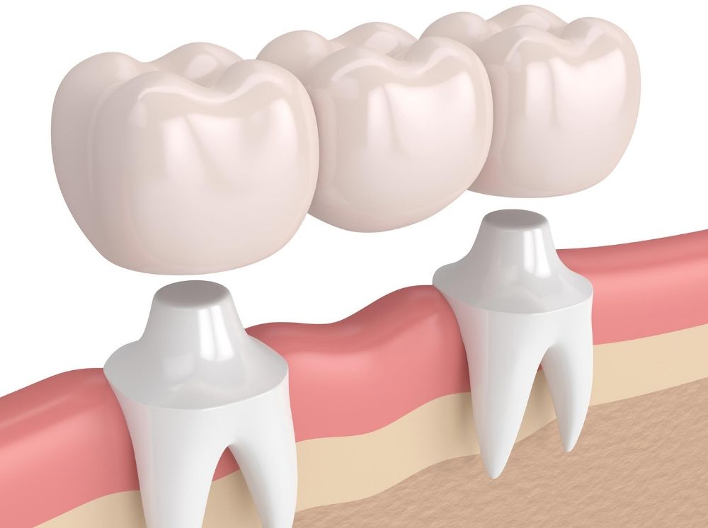 What to choose - Denture vs Bridge - Dr. Gaurav Malik - Max Dental Care
