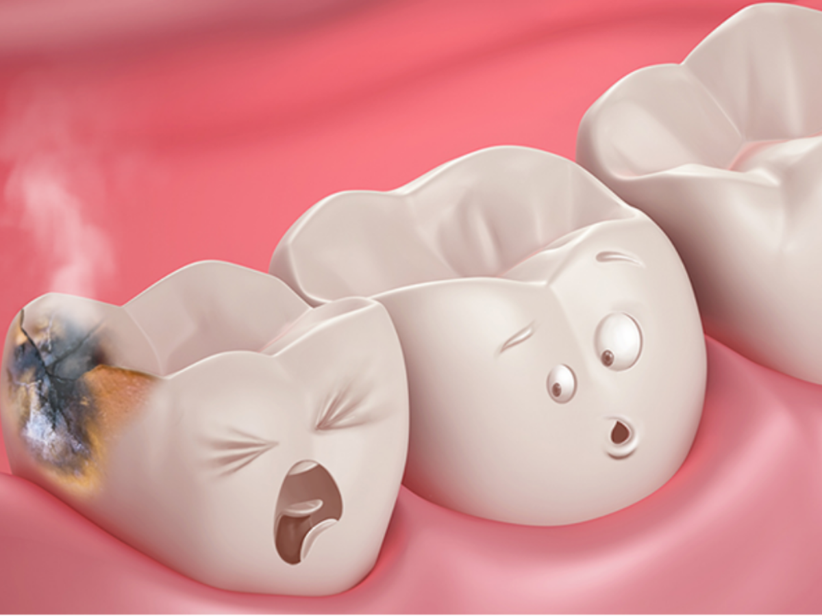 https://www.drgauravmalik.com/wp-content/uploads/2021/02/Blog-Dental-Cavity-Germs-or-Worms-1200x900.png