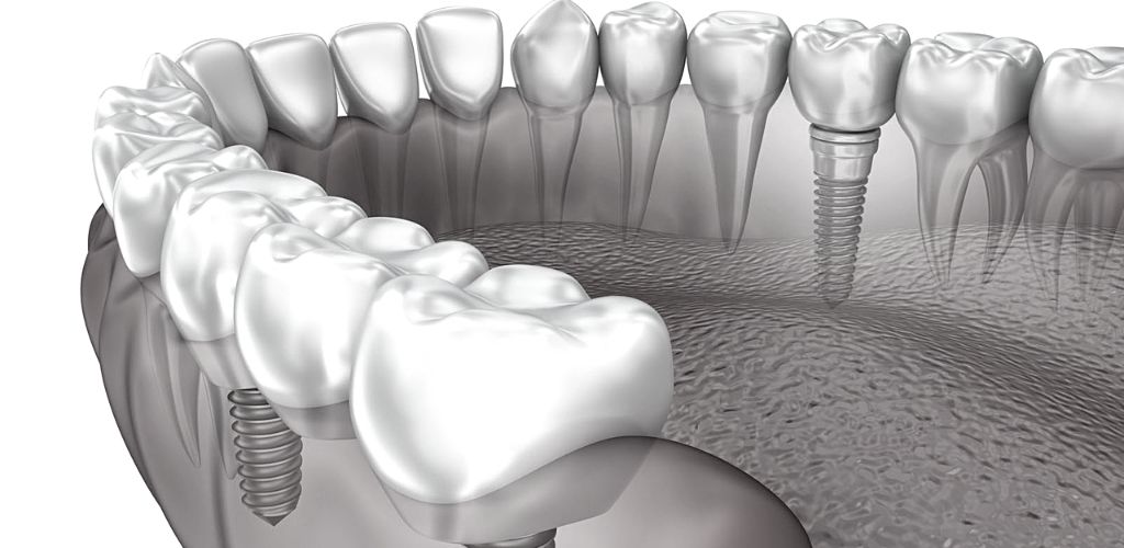 Dental-Implants